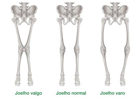 Varo E Valgo Do Joelho - Joelho Valgo e Varo: O que São, Causas, Sintomas e Tratamentos - Dr ...