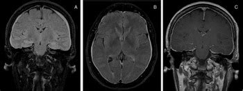 Chapter 42 Management Of PostDural Puncture Headache Anesthesia Key