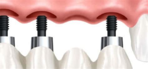 Oral Surgery Tips For Recovery From This Dental Treatment Dr Sunil