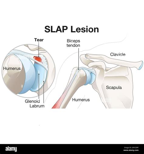 Shoulder Joint Labrum