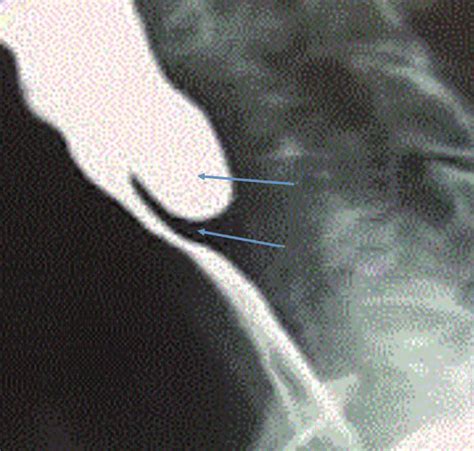 Lateral X Ray Shows The Anatomy Of A Zenker S Diverticulum Download Scientific Diagram