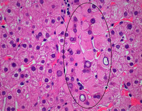 Pathology Pearls Post Chronic Viral Hepatitis Aasld