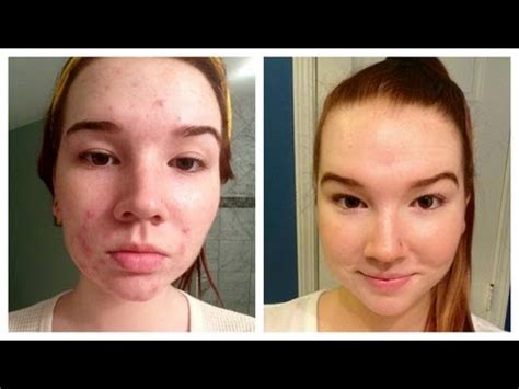 Sudocrem Acne Treatment Benefits and Instructions - BeautyHealthPlus