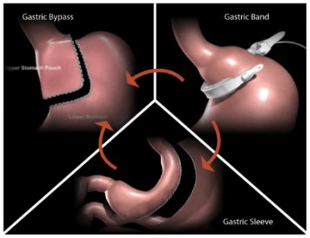 Lap Band Fail Dr Seun Sowemimo Specializes In Revision Bariatric