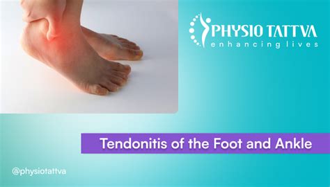 Foot And Ankle Tendonitis Causes Symptoms And Treatments