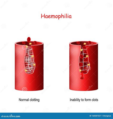 Haemophilia. Blood Vessel with Normal Clotting and Inability To Form