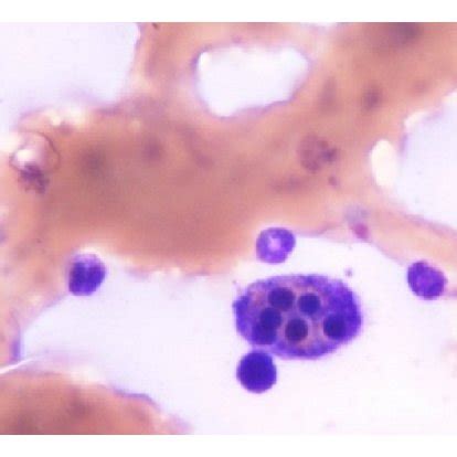 A Bone Marrow Aspiration Of Patient And B Bone Marrow Aspiration