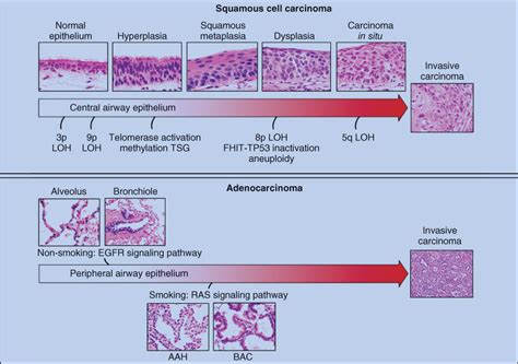 Pathophysiology Of Lung Cancer