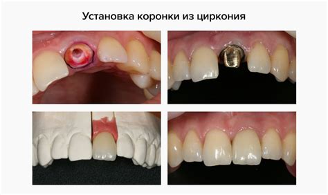 Циркониевые коронки — фото, установка, отзывы