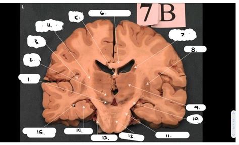 Brain Anatomy Flashcards Quizlet