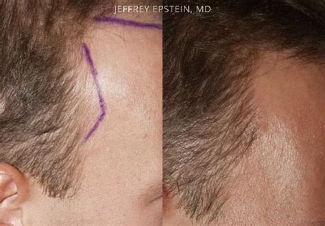 Hair Transplants For Men Photos Miami Fl Patient39875