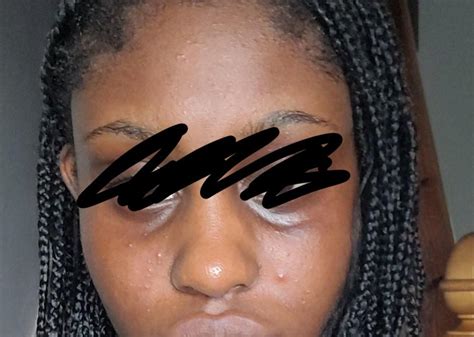 What are these lines under my eyes and how do I get rid of them? : r ...