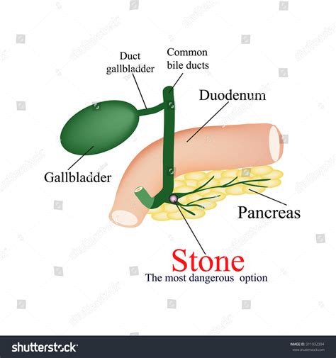 Stone Pancreatic Bile Duct Most Dangerous Stock Illustration 311932394