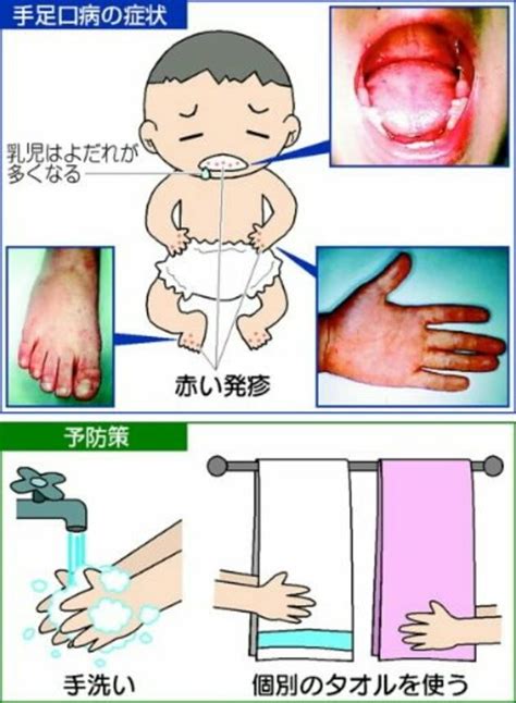 手足口病の症状と予防策【写真】 中国新聞デジタル