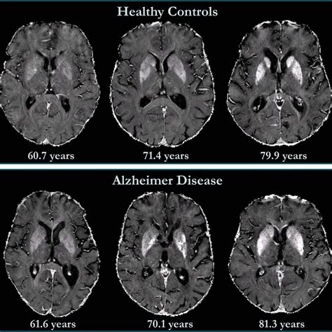 Salud Las Neuronas Despojadas De Su Identidad Son El Sello Distintivo De La Enfermedad De