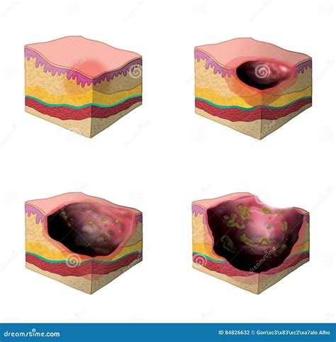 Skin Burn Classification Cartoon Vector 50132291