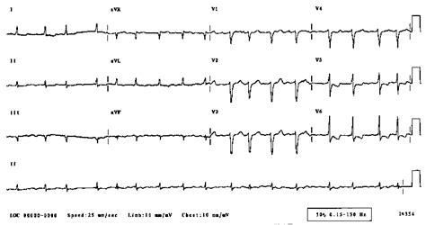 Digitalis Effect