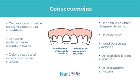 Tienes bruxismo 3 consejos para evitarlo Nart Clínica Dental