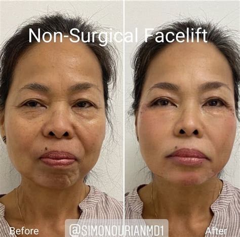 What Is The Best Non Surgical Facelift In Epione