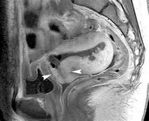 Эндометрит (эндомиометрит)