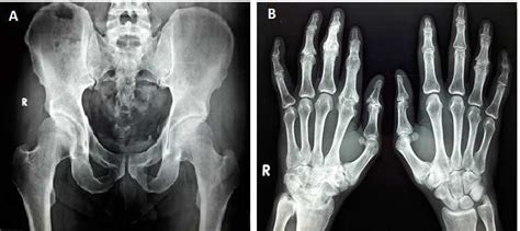 A Radiograph Of Sacroiliac Joints Subchondral Sclerotic Changes Are