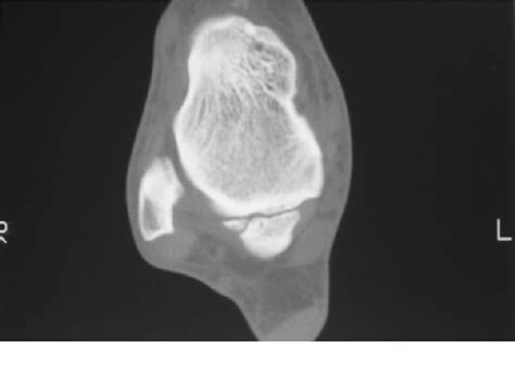 Figure 1 From Ankle Impingement Combined Anterior And Posterior Impingement Syndrome Of The