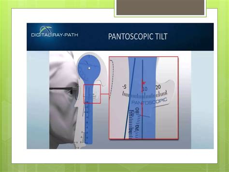 Pantoscopic Tilt Ppt