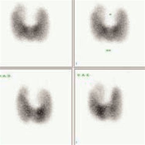 Patient S First Thyroid Scan Showing A 52 99m Tc Pertechnetate Uptake