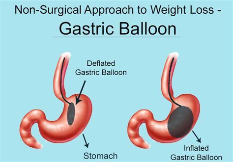 An Overview Of Gastric Balloon Surgery For Weight Loss Bariatric