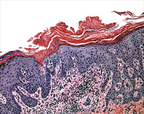 A Thick Lichenified Plaque On The Ventral Penile Shaft—quiz Case Urology Jama Dermatology