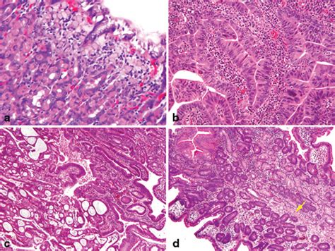 Pathology Of Gastric Cancer Abdominal Key