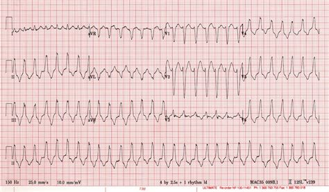 Supraventricular tachycardia (SVT). Causes, symptoms, treatment ...