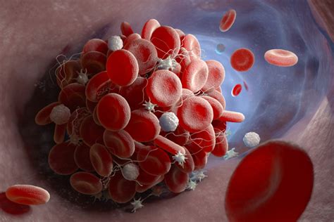 O Que É Um Coagulo - O Que é Coagulo No Sangue - NAZAEDU