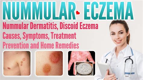 Nummular eczema causes, symptoms, treatment, prevention, and home ...