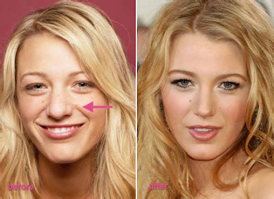Blake Lively Nose Job Before And After Plastic Surgery Boob Jobs Star Plastic Surgery