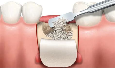 Understanding Bone Grafting In Dental Implants Procedures