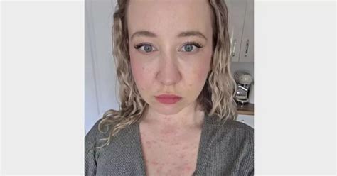 Mum Claims Dirty Hot Tub On Birthday Getaway Caused Absolutely Wild Rash Liverpool Echo