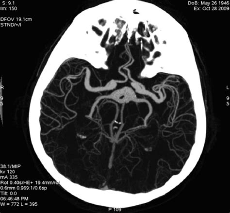 Cta Mip Reconstruction Dolichoectasia Of The Circle O Open I