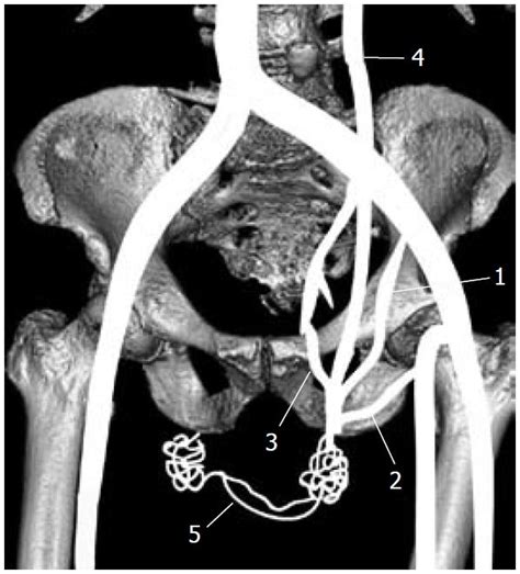 Pampiniform Plexus Ultrasound