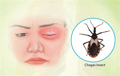 Chagas Disease: Causes, Symptoms, Diagnosis, and Treatment