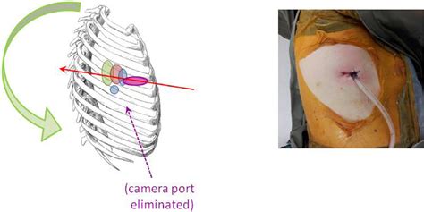 Figure From The Evolution Of Minimally Invasive Thoracic Surgery