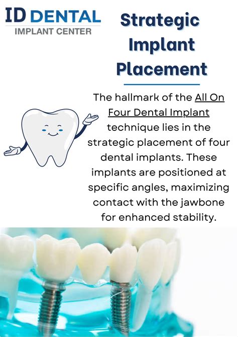 PPT Unveiling The Advantages Of All On Four Dental Implant PowerPoint