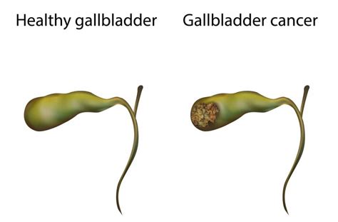 Gallbladder Cancer Treatment - Gallbladder Surgeon