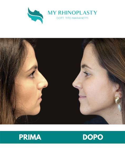 Rinoplastica My Rhinoplasty