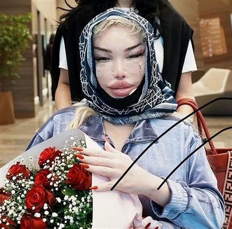 Jessica Alves, 41, Seen Leaving Hospital in Turkey Covered in Bandages