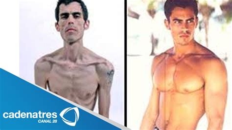 Bulimia Y Anorexia Un Mal Que Afecta A Hombres Y Mujeres Youtube