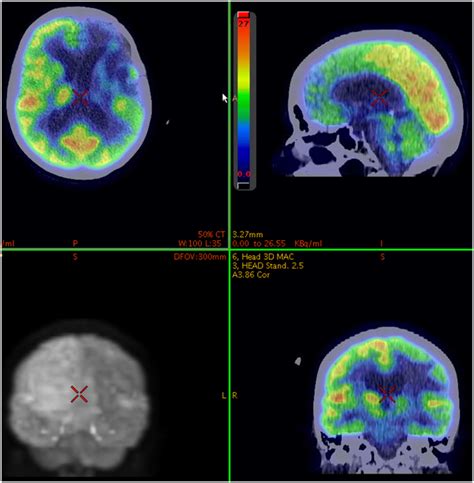 Dla Lekarzy Pozytonowa Tomografia Emisyjna Pet Tk Diagnostyka