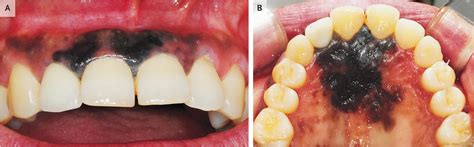 Oral Malignant Melanoma