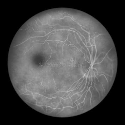 Diabetic Retinopathy Ophthalmoscopic Diagnosis Illustration Stock