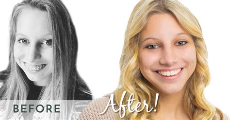 Before and After Braces Face Shape — Shoe Orthodontics Hanover, PA & Reisterstown, MD